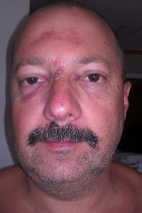 Buchanan, Joey Injuries