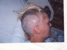 Doris - 1 day after the craniotomy - 2006