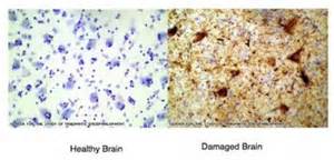 Healthy and Damaged Brain